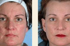 microdermabrasion-before-and-after