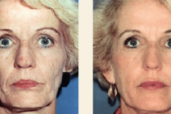 microdermabrasion-gold-coast-cost