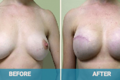 breast-reconstruction-before-and-after