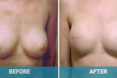 breast-reconstruction-gold-coast
