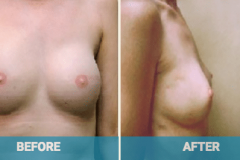 reconstruction-surgery-gold-coast