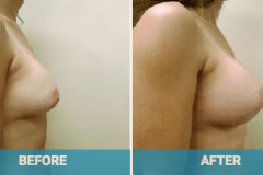 breast-revision-before-and-after