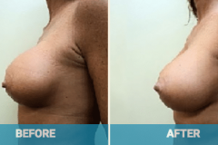 breast-revision-surgery-cost