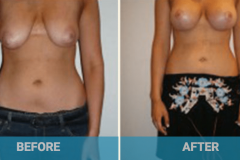 breast-lift-before-and-after
