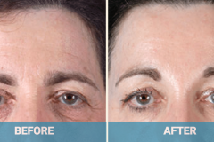 brow-lift-gold-coast-cost