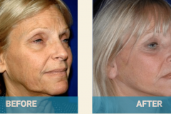 neck-lift-before-and-after-gold-coast