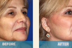 neck-surgery-cost-gold-coast