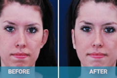 ear-reconstruction-and-shaping