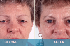 eyelid-surgery-before-and-after