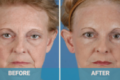 face-lift-before-after