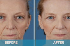face-lift-example