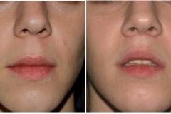 lip-surgery-before-after