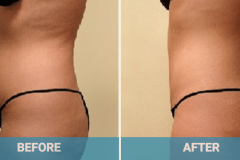 liposuction-cost-gold-coast