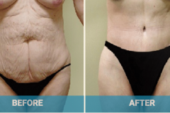 lower-body-before-and-after-gold-coast