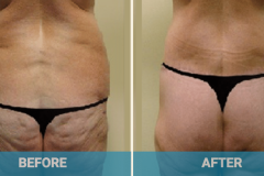 lower-body-lift-cost-gold-coast