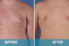 male-Gynecomastia-gold-coast