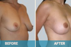 gold-coast-breast-lift