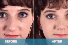 nose-surgery-gold-coast