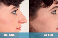 rhinoplasty-gold-coast-cost