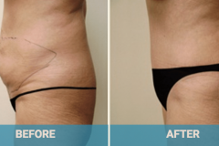 tummy-tuck-gold-coast-before-and-after