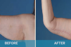 arm-lift-removing-flabby-skin